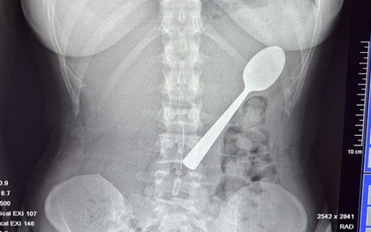 Đang ăn sữa chua, người phụ nữ nuốt chiếc thìa dài 17cm vào bụng