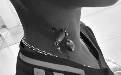 Bé trai 13 tuổi chảy máu nhiều, bác sĩ sốc khi phát hiện bí mật "đáng sợ" ở cổ