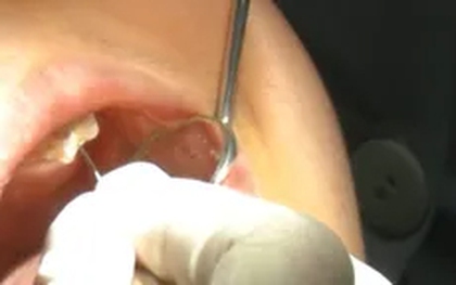 Từ một chiếc răng sâu, bệnh nhân đối mặt biến chứng hoại tử ngực nguy hiểm