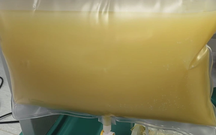 Nam sinh năm nhất "máu trắng như sữa", mỡ máu cao gấp 47 lần bình thường vì thói quen ăn uống nhiều người mắc