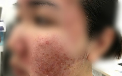 Cơn ác mộng của thiếu nữ chỉ sau vài giờ được mời làm đẹp cấp tốc đón Tết