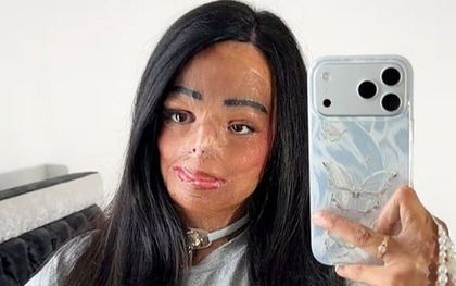 Dầu gội đầu bắt lửa, cô gái xinh đẹp bị bỏng nửa người và cái kết bất ngờ