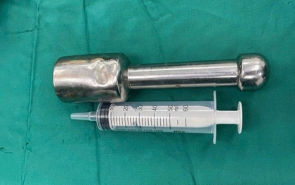 Chiếc chày 18 cm mắc kẹt trong trực tràng nam sinh 15 tuổi