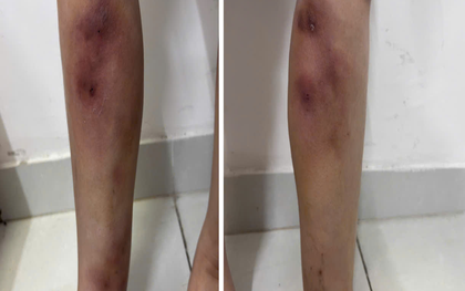 Cận cảnh đôi chân của cô gái 29 tuổi sau tiêm filler thẳng chân tại nhà