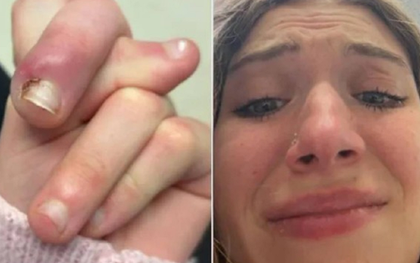 Người phụ nữ 21 tuổi suýt mất ngón vì thói quen "vạn người mê"