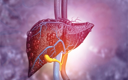 Có 1 dấu hiệu kéo dài suốt 3 tháng, người đàn ông đi khám phát hiện gan “dày đặc khối u”