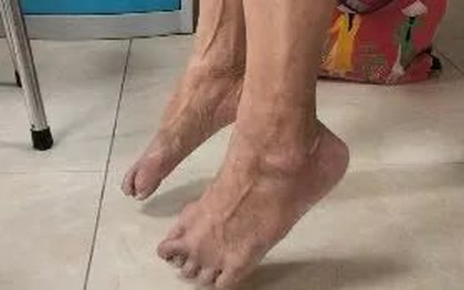 Hội chứng Guillain-Barré: "Kẻ ẩn danh" dễ gây nhầm lẫn trong thần kinh học