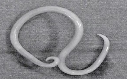 Thiếu niên 15 tuổi bị đau bụng thúc ngược lên, bác sĩ phát hiện "bí mật" đáng sợ bên trong