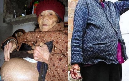 Cụ bà 91 tuổi ngã khi đi lấy nước, vào viện thì phát hiện “mang thai”: Bí mật về "bào thai hoá đá"