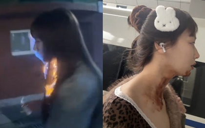 Nữ diễn viên bị bỏng nặng gương mặt ngay trong ngày sinh nhật tuổi 27 vì đu trend "bánh kem phun lửa"