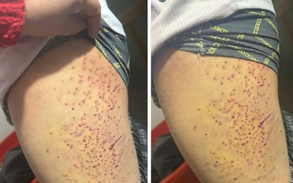 Xác minh thông tin học sinh nghi bị bạn dùng vật nhọn gây thương tích