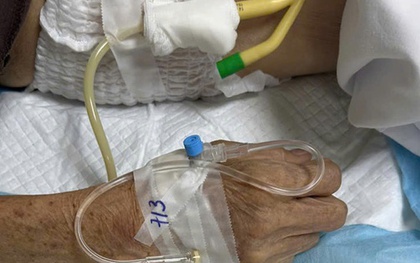 Cụ ông nhiều ngày bí tiểu, nước tiểu trắng đục như sữa