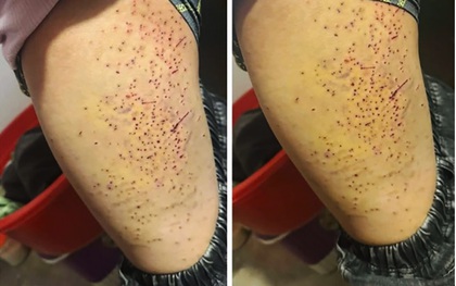 Nữ sinh lớp 7 dùng bút bi đâm hơn 20 lần lần vào đùi bạn học: Đây là nguyên nhân