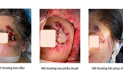 Ghép da thành công cho cô gái bị hoại tử vùng mặt sau tai nạn giao thông