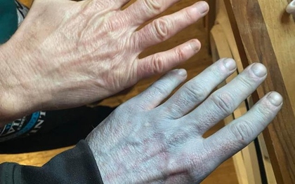 Toàn thân tím tái, người đàn ông vội đến bệnh viện và cái kết