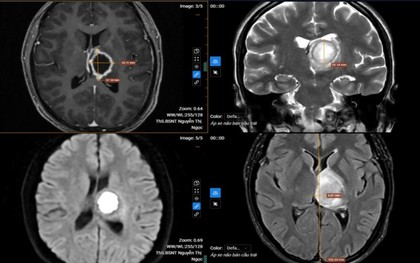 Thường xuyên buồn ngủ, đi khám “sốc” nặng khi biết nguyên nhân