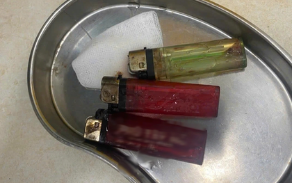 Bác sĩ sốc khi phát hiện 3 chiếc bật lửa trong bụng nam thanh niên