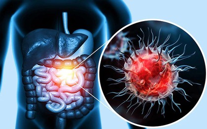 Ung thư đại trực tràng gia tăng đáng báo động: 4 dấu hiệu ở xa ''tít tắp'' có thể cảnh báo sớm