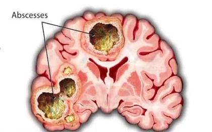 Phát hiện áp xe não nguy hiểm sau 2 tuần đau đầu, buồn ngủ triền miên