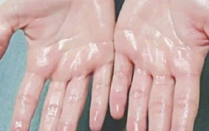 Cách kiểm soát tình trạng ra mồ hôi tay hiệu quả bậc nhất