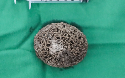 Người đàn ông 50 tuổi đau hạ vị kéo dài, bác sĩ sốc khi gắp ra thứ "đáng sợ" bằng quả trứng ngỗng