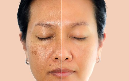 Oxy cao áp: Khi nào dùng để làm đẹp, chống lão hóa và kiểm soát bệnh chuyển hóa?