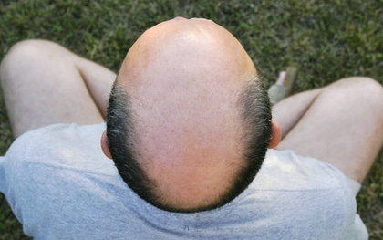 Trêu đàn ông là hói được coi là một dạng quấy rối tình dục