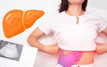 Với gan nhiễm mỡ, ngoài ''ngậm miệng và đá chân", còn có 1 việc bắt buộc phải làm mà nhiều người không biết