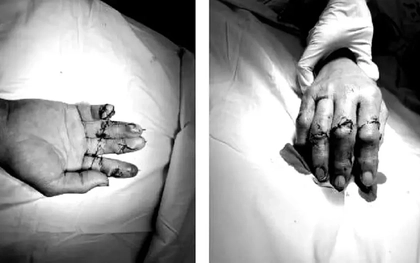 Xuyên đêm phẫu thuật cứu 4 ngón tay bị máy chém đứt lìa ở TPHCM