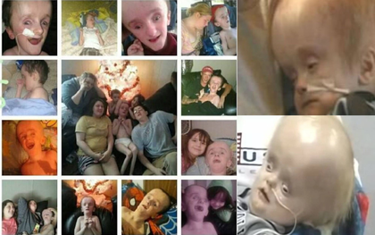 Cậu bé sinh ra không có não sống 12 năm cuộc đời thế nào?