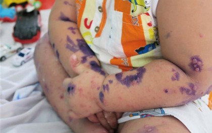 Gần 3.000 trẻ mắc chân tay miệng trong 2 tháng, 3 dấu hiệu cần đưa con đi viện