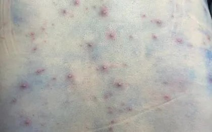 Cảnh giác với biến chứng nguy hiểm khi mắc bệnh thủy đậu