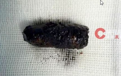 Mũi người đàn ông chảy dịch dai dẳng, bác sĩ phát hiện bí mật đáng sợ