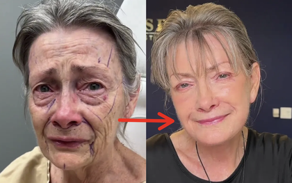 Bác sĩ thẩm mỹ được đặt lịch ồ ạt tới tận... 50 năm sau nhờ màn cải lão hoàn đồng thành công cho khách hàng