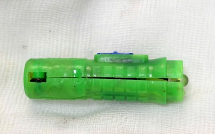 Bé 11 tuổi viêm âm đạo suốt 5 tháng, đến gặp bác sĩ Bệnh viện Phụ sản Hà Nội thì gắp được 1 vật hoen gỉ bên trong