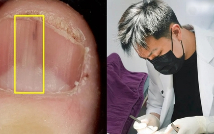 Người phụ nữ 45 tuổi phát hiện khối u từ 1 dấu hiệu ở móng tay nhiều người bỏ qua