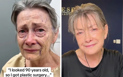 Cụ bà trông như 90 tuổi trẻ hóa kỳ diệu sau phẫu thuật căng da