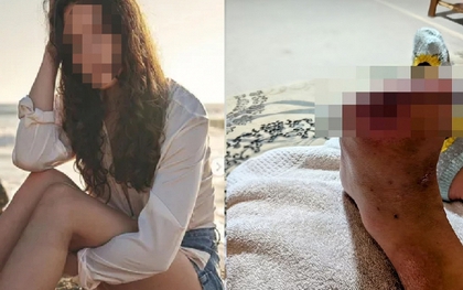 Cô gái 20 tuổi hoại tử, phải cắt bỏ 2 ngón chân vì mỗi ngày đều uống 1 loại nước "vạn người thích"