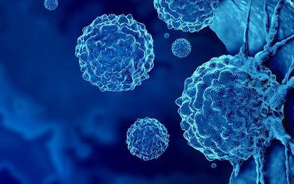 Loại ung thư đứng thứ 2 về tỉ lệ tử vong tại Việt Nam: 5 dấu hiệu sớm nhất ai cũng nên biết