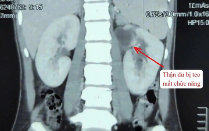 Kỳ lạ cô gái 22 tuổi có 3 quả thận