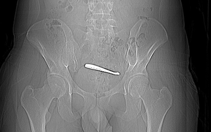 Người đàn ông đau bụng suốt 1 tuần, bác sĩ kiểm tra thì sốc nặng