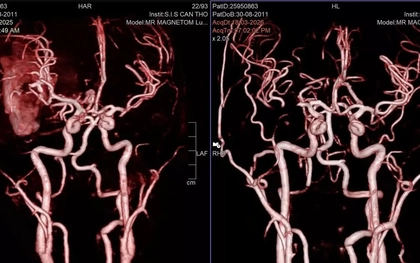 Cứu sống nam sinh hôn mê sâu do vỡ mạch máu não