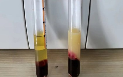 Vì sao tôi luôn kiểm soát mỡ máu nhưng khi khám lại vẫn không cải thiện, thậm chí bị nặng hơn?