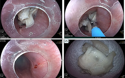 Liên tiếp 3 ca nuốt dị vật nguy hiểm dịp Tết