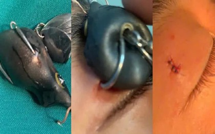 Tai nạn lưỡi câu móc vào mắt, nguy cơ tổn thương nghiêm trọng
