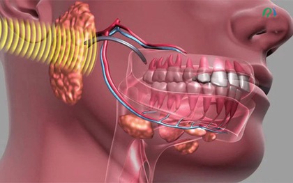 U xương hàm là bệnh gì? Dấu hiệu nhận biết sớm nhiều người dễ bỏ qua