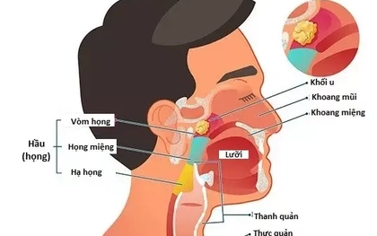 Người đàn ông mắc đồng thời hai ung thư nguy hiểm