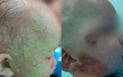 Bé 1 tuổi bị bỏng mặt, gia đình bôi đầy kem đánh răng theo “mẹo dân gian”: Bác sĩ cảnh báo có thể gây nhiễm trùng nặng