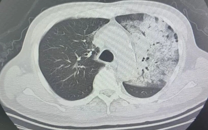 Người đàn ông sốt 40 độ C, phổi gần như "trắng xóa", chỉ vài ngày đã suy đa tạng: Thủ phạm liên quan đến thói quen nhiều gia đình vẫn mắc