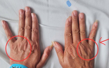 Tê ngón tay út tưởng chuyện nhỏ, người đàn ông 51 tuổi suýt bị teo cả bàn tay